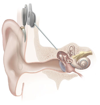 Illustration NIH d'un système d'implant cochléaire : processeur externe et récepteur interne — Crédit : National Institute on Deafness and Other Communication Disorders, NIH (domaine public)