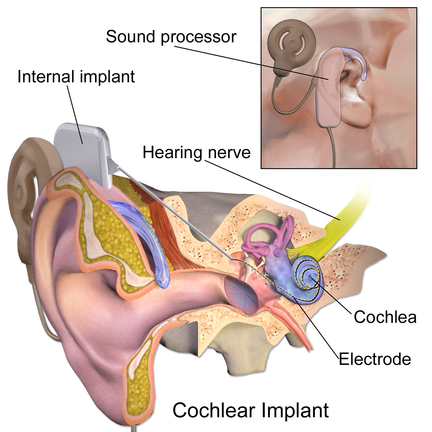 Schéma d'un implant cochléaire : la bobine externe et le processeur transmettent le signal à travers la peau au récepteur interne et au faisceau d'électrodes — Crédit : BruceBlaus, Wikimedia Commons (CC BY 3.0)