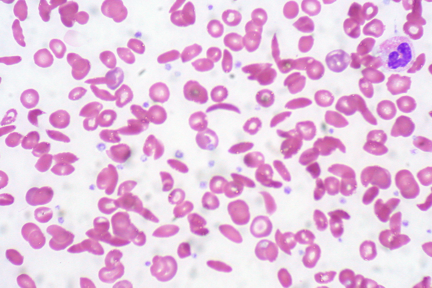 Un frottis sanguin d'un patient atteint de drépanocytose — les globules rouges allongés, en forme de croissant, sont ceux qui se coincent dans la circulation et provoquent la douleur. Crédit : Ed Uthman (Wikimedia Commons, CC BY 2.0)