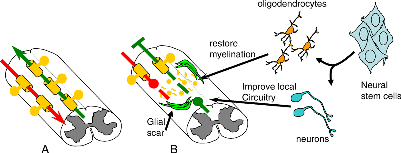 Comment une lésion médullaire coupe la ligne : une cicatrice gliale bloque le signal, et les chercheurs rêvent de restaurer la circuiterie par-dessus le trou. — Crédit : Lowry NA, Temple S / PLoS Medicine, via Wikimedia Commons (CC BY 4.0)